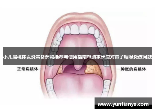 小儿扁桃体发炎常备药物推荐与使用指南帮助家长应对孩子咽喉炎症问题